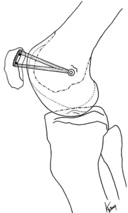 Fig. 3 Attachment of the Semitendinosus graft by two sutures anchors at the superomedial border of the patella and tendon to bone tunnel ﬁxation by an interference screw at the adductor tubercle