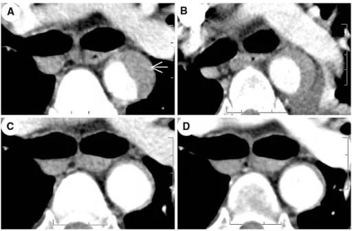 Fig. 2. Serial axial slices at the height of the tracheal bifurcation, A 2 hr, B 2 days, C 2 months, and D 8 months after