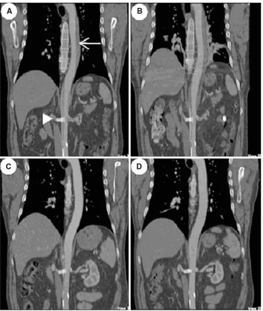 Fig. 3. CT curved reconstruction of the abdominal aorta descendens, A 2 hr, B 2 days, C 2 months, and D 8 months after dissection, showing the nearly complete regression of the dissection (arrow)