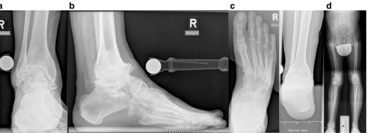 Fig. 2 Pre-operative planning. Pre-operative weight-bearing anteropos- anteropos-terior radiograph is used for the planning of a supramalleolar medial closing wedge osteotomy