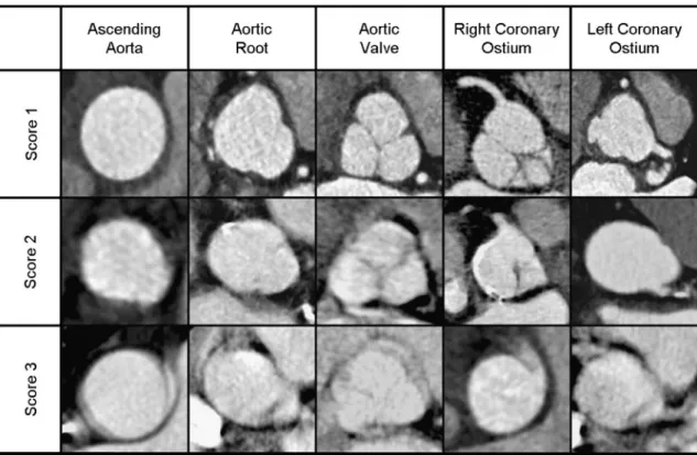 Fig. 1 Schematic presentation of the aortic valve-aortic root complex that was investigated in this study with three different CT protocols.