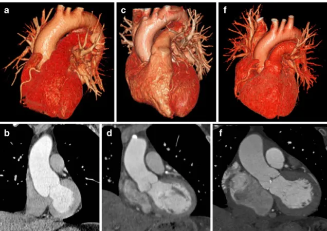 Fig. 3 Volume renderings and corresponding double-oblique coronal reformations of the aortic root in three representative patients undergoing ECG-gated high-pitch (a,b; left), non-gated high-pitch (c,d; centre), and retrospectively ECG-gated standard-pitch