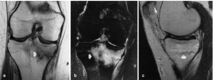 Fig. 2 Frontal radiograph of the right knee 3 months after the onset of acute atraumatic knee pain with an area of sclerosis in the