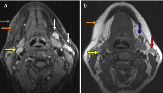 Fig. 1 MRI of a 45-year-old female victim 4 h after strangulation displaying lymph node haemorrhage and oedema, intra- and subcutaneous haemorrhage