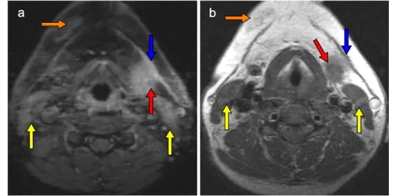 Fig. 2 Twenty hours after strangulation, the MRI of this 36-year-old female patient shows haemorrhagic swelling of platysma,  rhage around the submandibular gland and subcutaneous  haemor-rhage