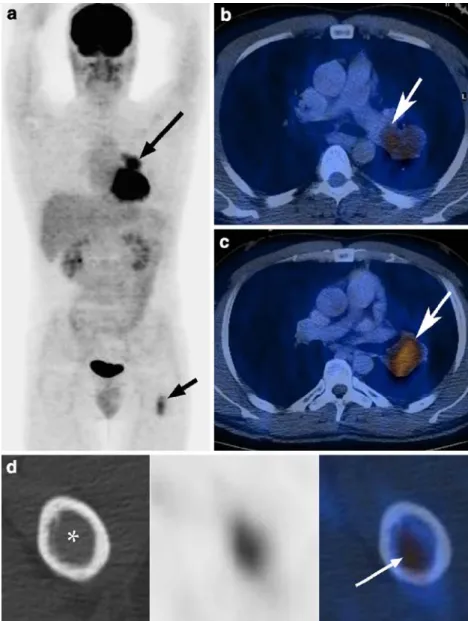 Fig. 1 MIP image (a) demon- demon-strating an increased FDG  up-take (SUV max. 4.1) centrally in the left lung (long arrow) and in the proximal left femur  di-aphysis (short arrow)
