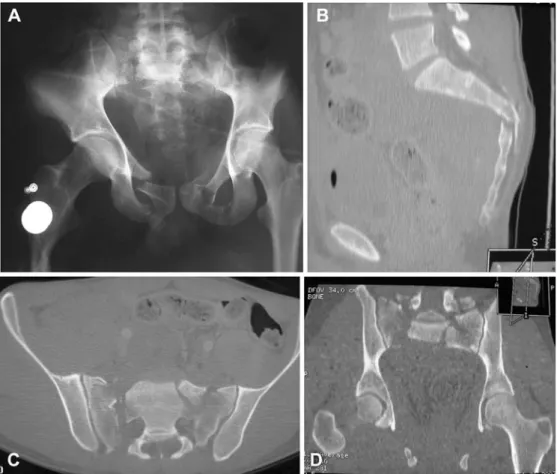 Fig. 1 A Pre-operative antero posterior X-ray, and CT scan, B sagittal view, C coronal view, D frontal view, of an H sacral fracture