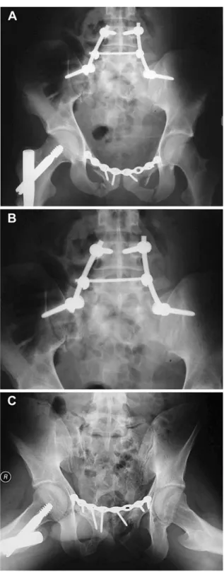 Fig. 3A-C Post-operative X-ray view of lumbo-iliac ﬁxation. A Antero posterior view, B AP localized view, C X-ray after healing and removed material