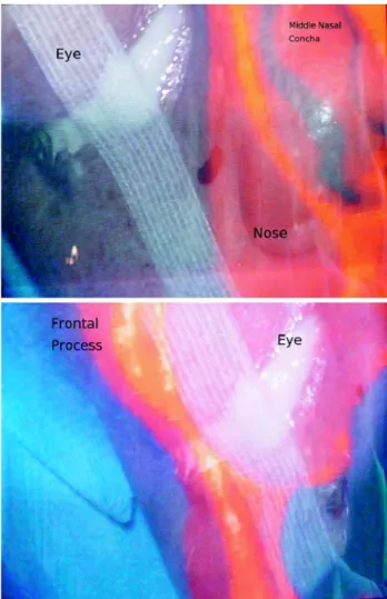 Fig. 12 Use of our image-guided microscope system in the oper- oper-ating room. The sterile bag used to cover the microscope also encloses the tracker, ensuring safety and optimized ergonomics