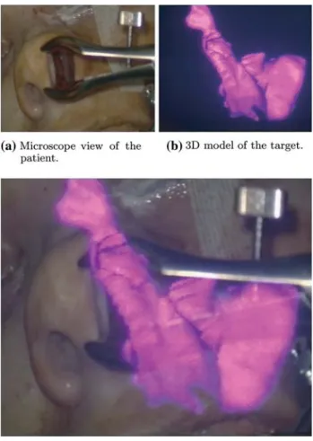 Fig. 14 The 3D model of the malignant tumor segmented from the CT dataset of the patient is rendered and displayed directly to the microscope view