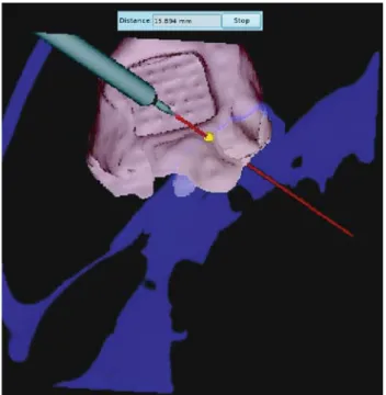 Fig. 8 Image projected to the microscope: 3D model of a simu- simu-lated tumor(red) and a CT cut-view (blue)