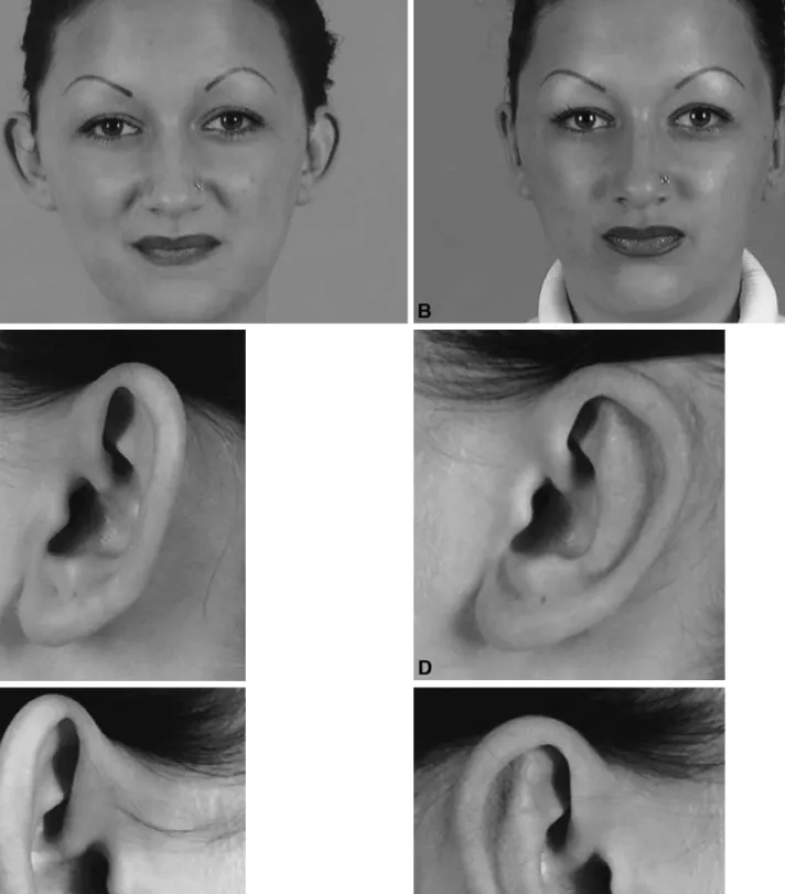 Fig. 2. Evaluation of the cosmetic result of a Francesconi otoplasty using the grading system of Strasser [17] for a 20-year-old woman