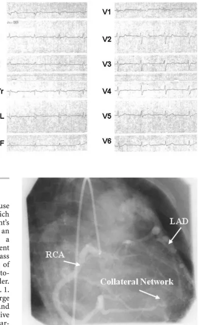 Fig. 2 Coronary angiography showing a large right coronary artery (RCA) with collateral filling of the left anterior descending coronary artery (LAD) and contrast entry into the pulmonary trunk by a collateral network