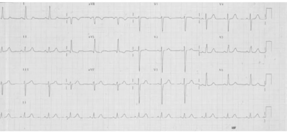 Fig. 3 Electrocardiogram from a 39-year-old woman with anomalous origin of the left  coro-nary artery from pulmocoro-nary artery (case  de-scribed in reference [16]) showing Q waves and negatives T waves in leads I and aVL