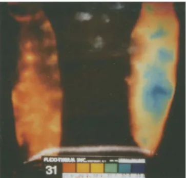 Fig. 1  LCCT finding in the ventral lower leg showing regional hy-  perthermia on the left side laterally  (blue area) 