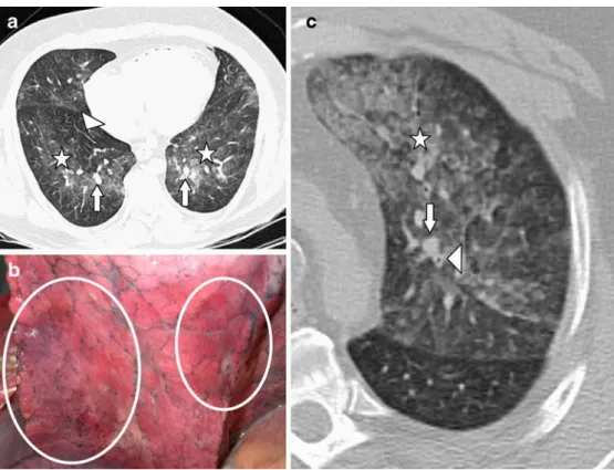 Fig. 3 On the left side, broncho- broncho-arterial-coefficient of a drowning case, indicating bronchospasm and/or hyperperfusion (a artery, b bronchus)