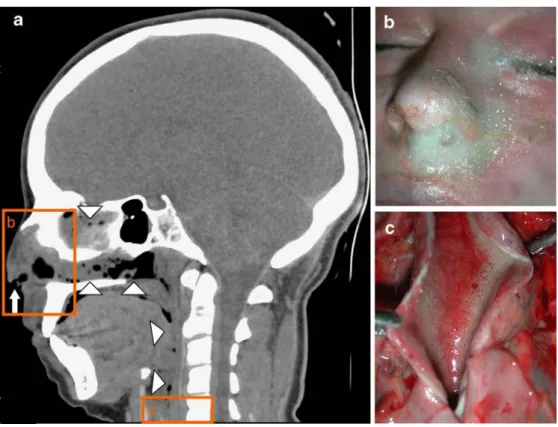 Fig. 5 a, b Haemodilution. a Measurement of the blood  den-sity in the right dilated atrium in a drowning case shows 45 HU, indicating possibly increased water content (arrow)