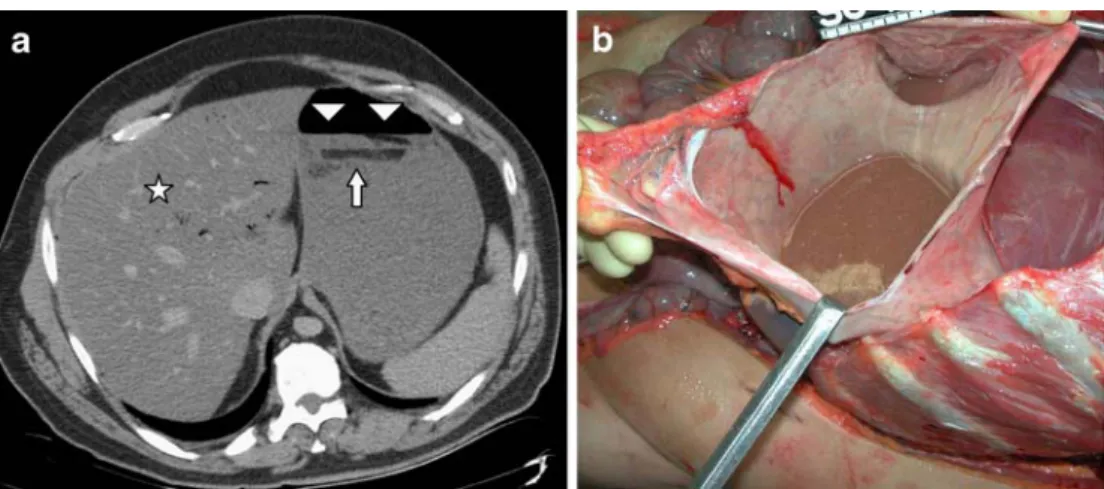 Fig. 7 Water in the paranasal sinuses on an axial CT image. The maxillary sinuses show air/fluid levels in a drowning victim (arrowhead)
