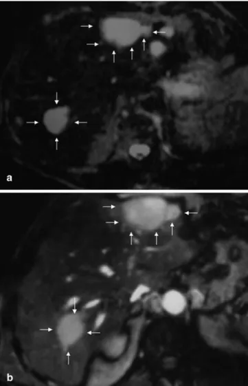 Fig. 1 a Arterial-phase CT scan of the liver reveals two large hy- hy-poattenuating and ill-defined liver lesions in liver segment 3/4a in a subcapsular location and in liver segment 7, respectively (arrows).