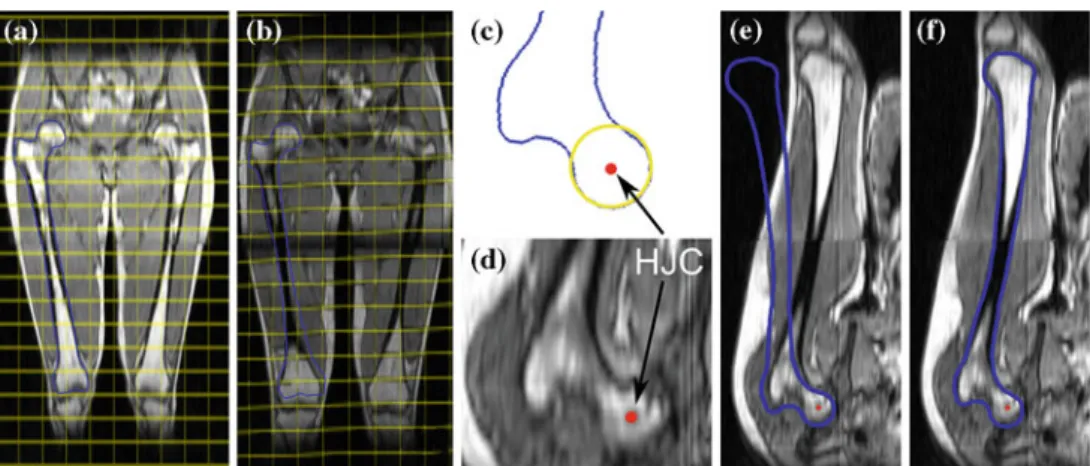 Fig. 4 Registration-based initializations for supine (a, b) and split (c–f) images. a–b non-rigid registration between a atlas and b subject’s supine MRI: blue overlay represents the a atlas and b the transformed right femur with the computed transformatio