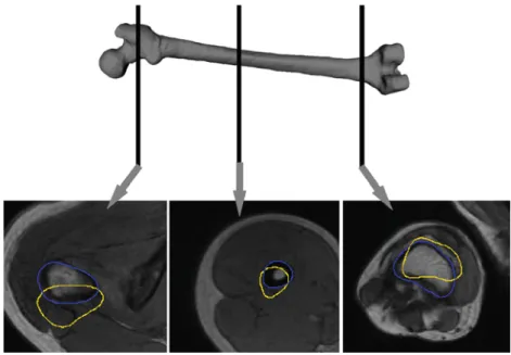 Fig. 11 Example of worst case of split initialization (yellow) compared with the fine segmentation results (blue), which are significantly better (decrease of ASSD from 4.57 to 1.03 mm)