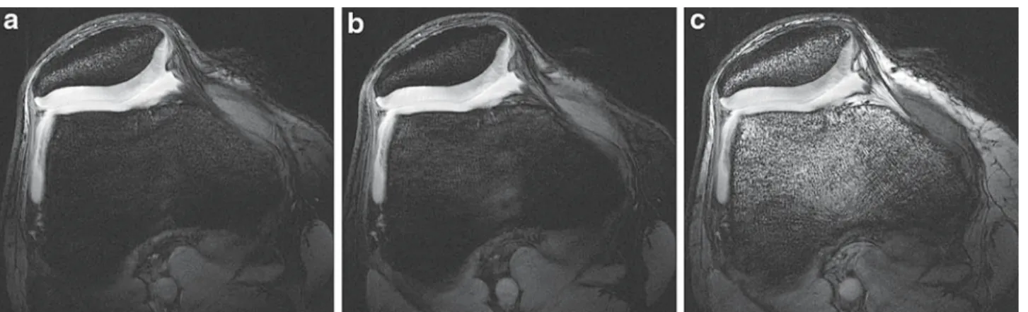Fig. 3 Axial 3D DESS images of the patella of the knee joint at 7.0 T using a surface single loop coil