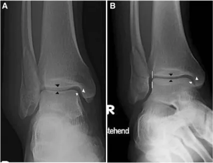 Table 1 Clinical results according to the AOFAS ankle-hindfoot score at latest follow-up (mean 63 months), by questionnaire AOFAS-score (max