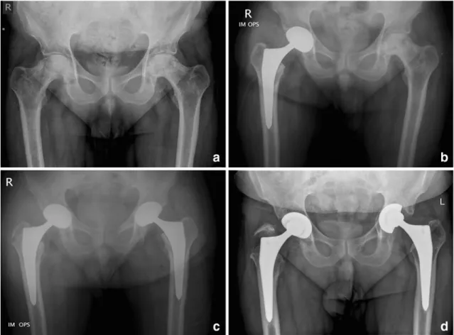 Fig. 1 X-ray of a 44-year-old man with bilateral osteonecrosis of the femoral head (a)