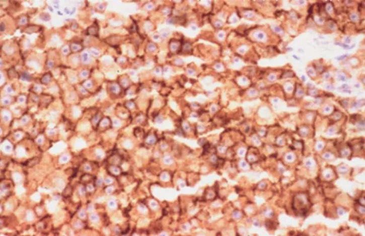 Fig. 1 Example of a CD 117-positive tumor (magnification 100)742