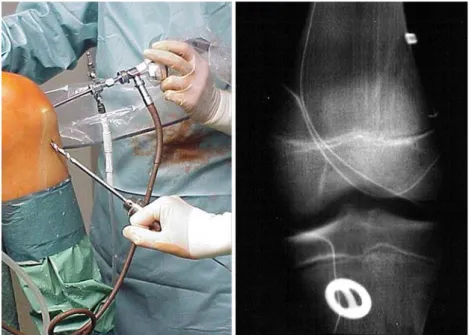 Fig. 3 Hand-drilled tunnels in Pforzheim using the Aesculap technique with hamstring  ten-don, post-OP X-ray