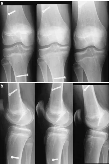 Fig. 4 X-ray series from Bruderholz with 2-year follow-up, removal of the tibial screw after skin irritations