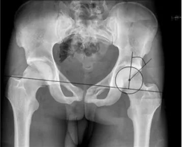 Fig. 1 Measurement method of the Wiberg ' s lateral center edge angle on conventional radiographs with PACS