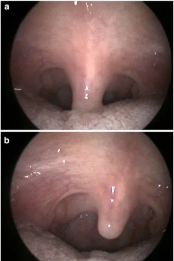 Fig. 1 a Soft palate at presentation. No obvious asymmetry can be seen at rest. b Velar shift towards the left side during contraction (on phonation), due to right hemivelar palsy