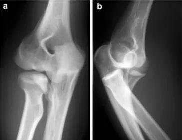 Fig. 1 a Anteroposterior and b lateral view of the fracture- fracture-dislocation