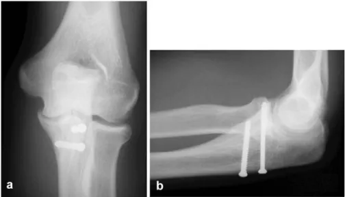Fig. 3 a Anteroposterior and b lateral view of the fracture reduction and ﬁxation