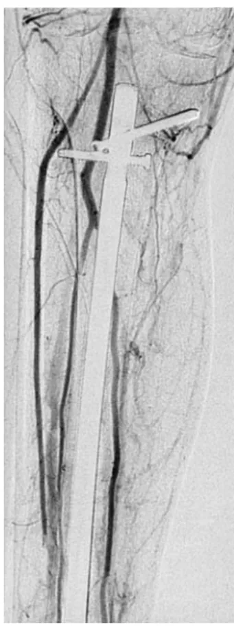 Figure 6. Interruption of the  anterior tibial artery in the  mid-dle of the tibia (Case 2).