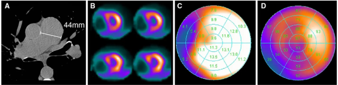 Figure 8. A 66-year-old woman with known chronic obstructive pneumopathy referred for cardiac risk assessment before wedge resection