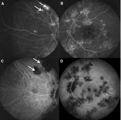 Fig. 2 Angiographic frames 2 months after presentation. FA (A, B) shows new lesions (arrows), but ICGA (C, D) shows new hypofluorescent lesions which are much more widespread (arrows)