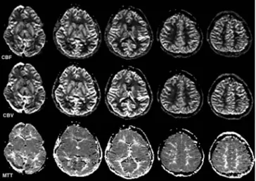 Fig. 6 The CBF, CBV and MTT maps in a healthy 8-year-old child. The CBF and CBV is larger in the grey matter than in the white matter