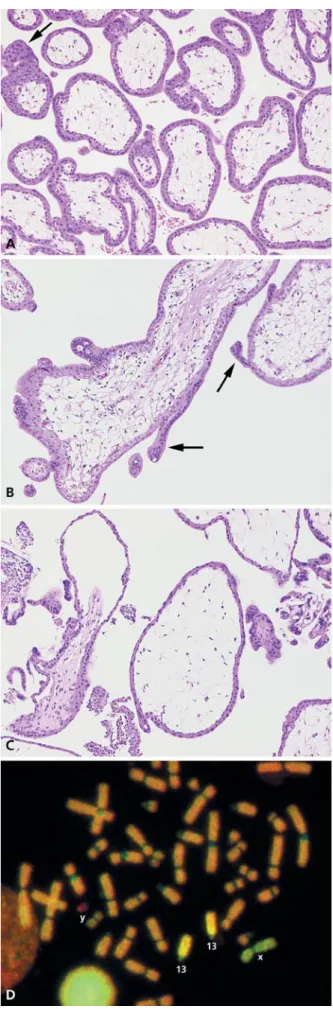 Fig. 1 Early chorionic villus morphology and karyotype. A Normal chorionic villi show uniform branching architecture, trophoblast layering and stromal density