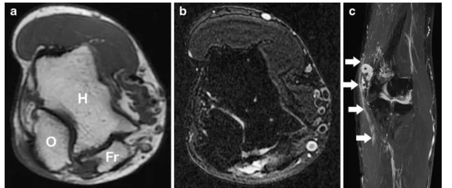 Fig. 4 A 43-year-old male patient who had a motorcycle accident 8 months ago with resulting chronic elbow pain, hand muscle weakness, and a normal electrodiagnostic ulnar nerve test