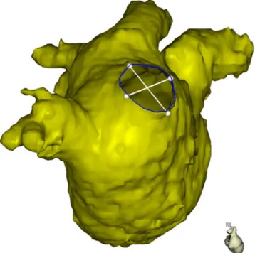 Fig. 1 MRI reconstruction of the left atrium in a right lateral view.