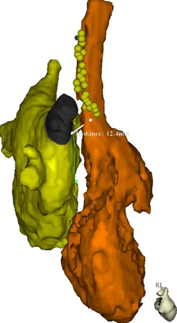 Fig. 2 MRI reconstruction of the left (yellow) and right (orange) atrium in a right lateral view showing the course of the right phrenic nerve in a random patient undergoing ablation of atrial fibrillation