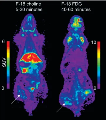 Fig. 2. FCH and FDG PET. Shown is a slice with a thickness and pixel size of 0.5 mm. The abscess (arrows) is clearly visualised with FCH (on the left) and FDG (on the right)