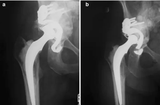 Fig. 1 a: Post-operative AP radiograph of the pelvis after allograft with a Kerboull ring.