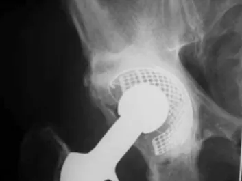 Fig. 3 Postoperative AP radiograph of the pelvis showing complete and stable reconstruction of a Type-II defect six years after surgery.