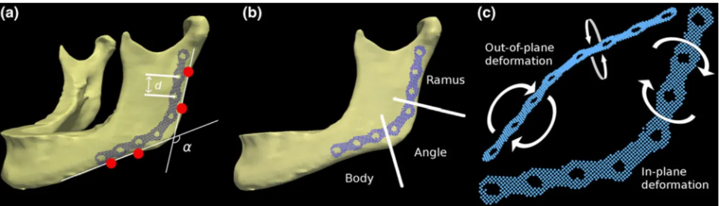 FIGURE 1. 3D view of the reference mandible with the standard fixation plate placed in its correct location