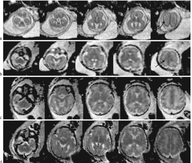 Fig. 2 Representative ADC maps at five different levels, from the cerebellar hemispheres, the midbrain, the thalamus, the lentiform nucleus and the centrum semiovale taken at the 24th (a), 28th (b),