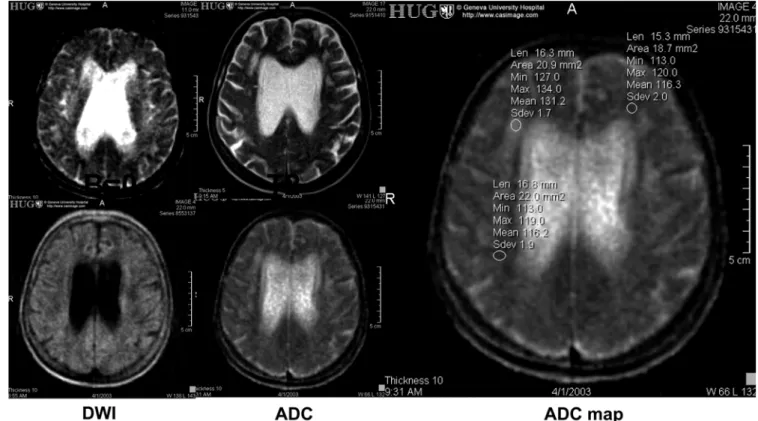 Fig. 2 An 83-year-old woman with recent development of cognitive changes: the T2-weighted images in the upper left corner (far left: