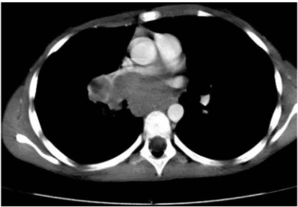 Fig. 3 Follow-up, coronal contrast-enhanced MRI, 2 months after start of chemotherapy shows new tumour within the left cavernous sinus